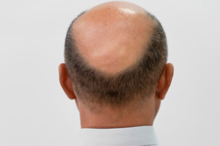 Hair loss causes