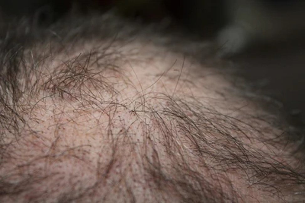 Lupus Hair Loss