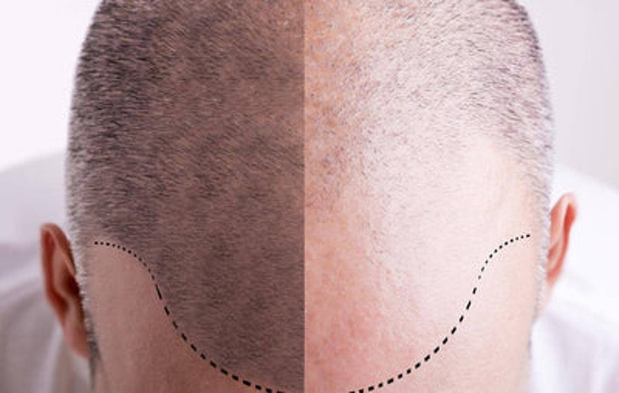 Hair Transplant Recovery